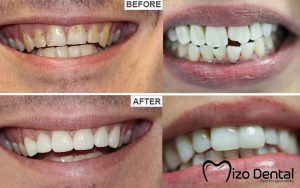 boc-rang-su-tai-mizo-dental