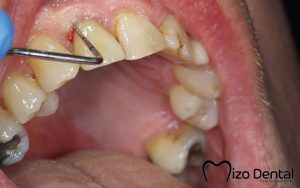 quy-trinh-trong-rang-implant